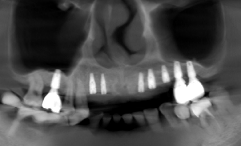 植牙術前X光