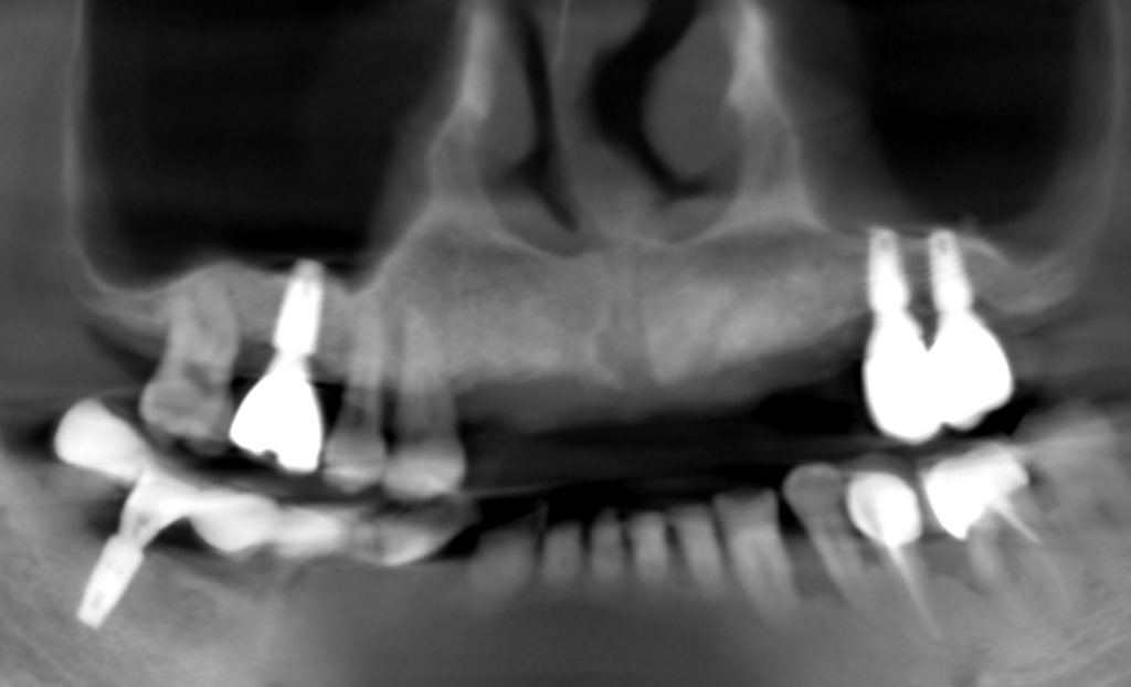 植牙術後X光